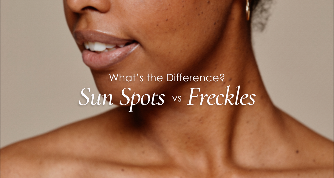 Spot the Difference: Sun Spots vs Freckles | Black Girl Sunscreen